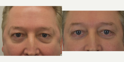 55-64 year old man treated with Brow Lift - We used some botox to lift the brow. You can typically get 1-2mm lift with neurotoxins alone. If you want more surgery is likely the best option.Best,DrC