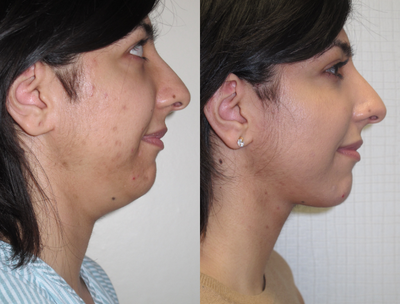 25-34 year old woman treated with Chin Liposuction - Vaser liposuction to the chin. VASER is an excellent lipo technique for the chin and neck since it is gentle, less invasive and minimises bruising and swelling