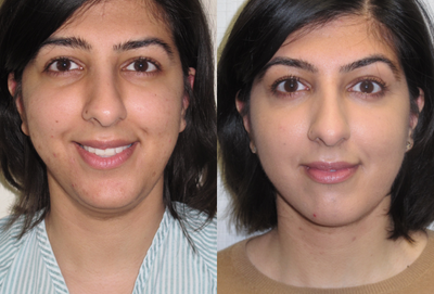 35-44 year old woman treated with Chin Liposuction - Vaser liposuction to the chin. VASER is an excellent lipo technique for the chin and neck since it is gentle, less invasive and minimises bruising and swelling