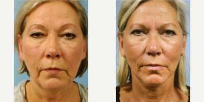 Woman treated with Lower Facelift - Woman treated with Lower Facelift