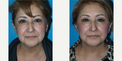 Woman treated with Lower Facelift - Woman treated with Lower Facelift