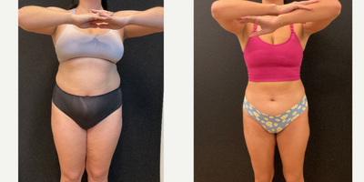 25-34 year old woman treated with Semaglutide - 60lbs weight loss with Semaglutide