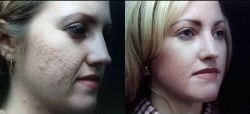 Microdermabrasion - 	Female Microdermabrasion
