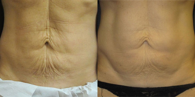 35-44 year old woman treated with Skintyte - SkinTyte 2 months after 3 treatments