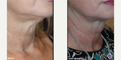 45-54 year old woman treated with eMatrix - The doctor used Ultherapy and Sublative treatments to tighten her patient's neck and jawline area.