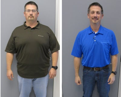 Before & After - 12 months post-op