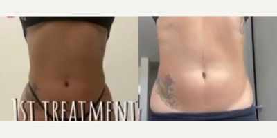 Woman treated with BodyFX - Burns fat, tightens skin . Loose inches and get snatched !!!