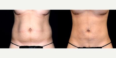 30 year old woman treated with Smart Lipo - 30 year old woman treated with Smart Lipo. Photos depict before and 7 months after surgery.