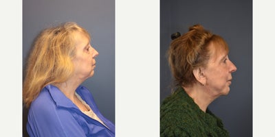 Woman treated with Facelift, Neck Lift - Woman treated with Facelift, Neck Lift