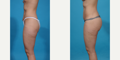 25-34 year old woman treated with Brazilian Butt Lift, Brazilian Butt Lift Revision, Butt Augmentation, Butt Lift, Liposculpture - Skinny BBL. This patient wanted better shape and curves without too much volume. A skinny BBL prioritizes shape over size and is perfect for athletic women who just need a better shape, more curves, and projection but don't want too much volume in their butt. We call this a skinny BBL.