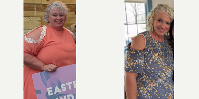 Gastric Sleeve Surgery - 35-44 year old woman treated with Gastric Sleeve Surgery