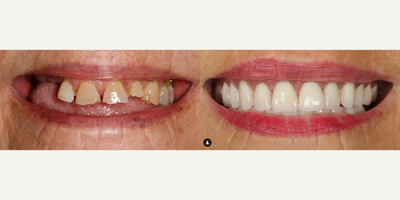 Woman treated with Porcelain Veneers, Dental Crown, Smile Makeover - Woman treated with Porcelain Veneers, Dental Crown, Smile Makeover