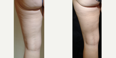 25-34 year old woman treated with Cellulaze - Grade II cellulite with one treatment of Cellulaze