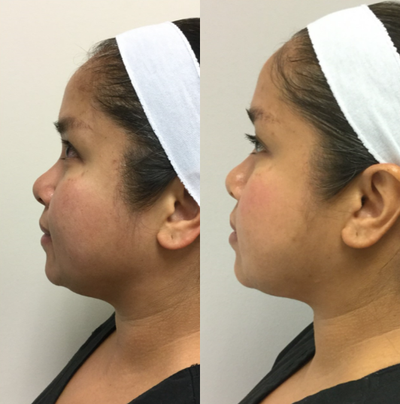 35-44 year old woman treated with Secret RF - 42 yr old female with Secret RF to face and neck. She had 3 treatments 4 weeks apart for 3 months.