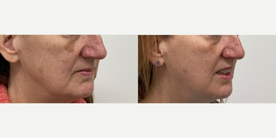 55-64 year old woman treated with BBL IPL - This patient is 1 month post procedure following 1 BBL (broad band light) treatment.
