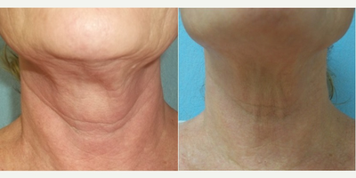 64 year old woman treated with InMode Fractora to neck - High energy treatment of InMode Fractora to the neck.