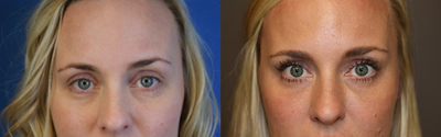 35-44 year old woman with Voluma to midface and browlift - Notice the lift that the Voluma provides to the midface, bringing it closer the lower eyelid and bridging the gap without giving the overfilled, fake cheek look.  She also had a brow lift to open her upper lids with the Voluma.