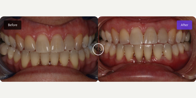 Woman treated with Gum Lift - Woman treated with Gum Lift