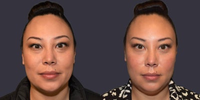 35-44 year old woman treated with Eyelid Surgery, Chemical Peel, TCA Peel - This 36 year old presented requesting improvement in her puffy lower eyelids. She had a lower eyelid lift with a hidden incision inside the eyelid, (trans-conjunctival lower blepharoplasty), and TCA chemical peel of the skin around the eyes.