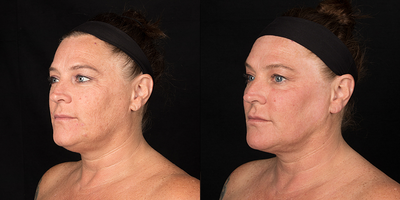 Woman treated with Renuvion - Woman treated with Renuvion