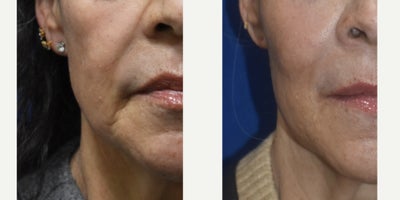 Sculptra Injections Los Angeles - Sculptra is awesome.  What traditional hyaluronic acid filler can get you natural looking results like these AND last 3 years or more?  None that I know of.  Sculptra creates your own collagen and that's what makes it look so good!