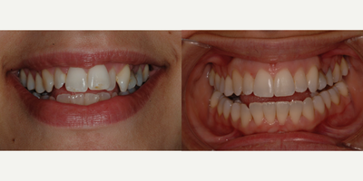 25-34 year old woman treated with Clear Braces - Invisalign clear braces