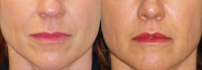 25-34 year old woman treated with Lip Lift - A Lip Lift is a surgical procedure to shorten the space between the nose and the top lip, to give the appearance of a fuller top lip and the show more teeth when you smile.
