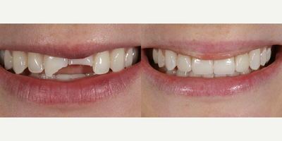 18-24 year old woman treated with Tooth Repair - 18-24 year old woman treated with Tooth Repair after Trauma to front teeth.  Combination of all Porcelain Crowns and Porcelain Veneers.
