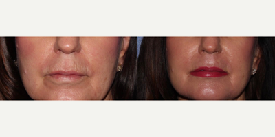 55-64 year old woman treated with Scar Removal, Laser Resurfacing - Laser resurfacing around the mouth