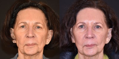 65-74 year old woman treated with Radiesse - Radiesse