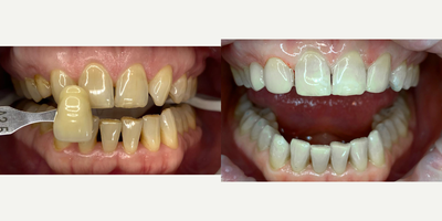 45-54 year old woman treated with Lumineers - We applied office type bleaching and lumineers with porcelain filling to our patient.