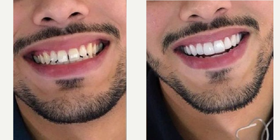 Treated with BriteSmile - teeth space closing and color enhancement for a brighter smile!