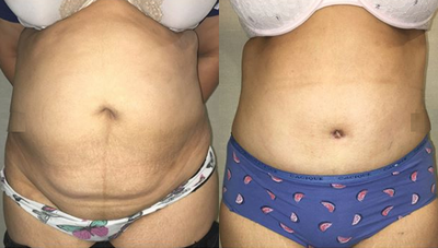 Woman treated with Drainless Tummy Tuck - Woman treated with Drainless Tummy Tuck
