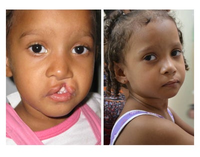 Cleft Lip and Palate Repair - 
	This five year old girl had an incomplete cleft lip and flattened nose, as well as a cleft palate. She underwent two surgeries with Dr. Ransom, including a cleft lip repair and then, a year later, a cleft palate repair. A year post-op
