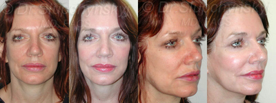 Mid 50s Female Cheek Augmentation with Implants - Cheek augmentation performed using implants.