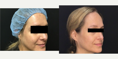35-44 year old woman treated with GentleLase - This patient has sun-damaged skin and was treated with an alexandrite laser for her brown spots with great results.
