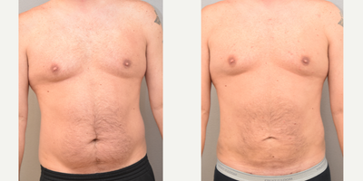 38 year old man treated with Tumescent Liposuction - SAFE liposuction technique abdomen and flanks