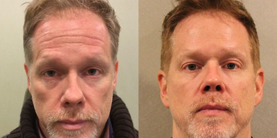 45-54 year old man treated with Voluma to his cheeks and botox to his forehead - My patient wanted some help to refresh his look. He was not ready for surgery so we opted for Botox to soften the lines on his forehead and around his eyes and voluma to augment his cheeks and soften the under eye hollows. We only used 2 syringes of voluma. He looks refreshed, rejuvenated and rested.