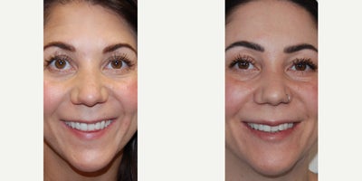 Lip Augmentation Before & After: Three Treatments with Silikon-1000 - Our patient is an excellent example of the precision, permanence, safety, and natural appearance of Silikon-1000 injections for permanent lip augmentationthree treatments were performed. Her first two treatments were administered over four years ago, and she visited our office one month ago for a third treatment. We are grateful that she has allowed us to share her photos! Unlike temporary gel fillers like HA, permanent lip augmentation with Silikon-1000 never leads to complications such as necrosis, embolism, stroke, blindness, infection, or biofilm. Additionally, we believe it creates a much more natural lip appearance, and we have not seen any cases where the filler migrates from the pink part of the lip to the white part.