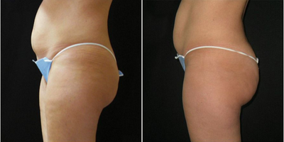 UltraShape - Photos provided courtesy of Syneron & Candela, performed by D. Ad-El, MD