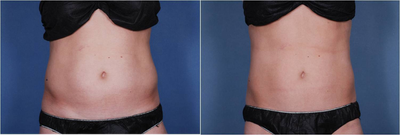 Liposonix - Liposonix noninvasive fat reduction with focused ultrasound