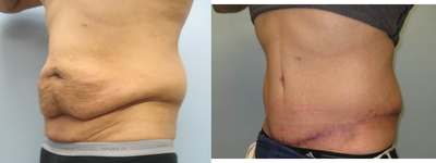 38 year old male treated for excess tummy skin - This 38 year old male lost about 40 pounds through diet and exercise and wanted to get rid of the roll of skin and fat along his waist. He opted for a tummy tuck and liposuction of the hips.