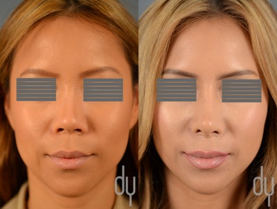 Before After Asian Rhinoplasty with Rib Cartilage Harvest and Diced Cartilage Fascia (DCF) - Before After Asian Rhinoplasty with rib cartilage harvest and diced cartilage fascia (DCF).  DCF used to augment the dorsum, and tip refinement performed with a septal extension graft, extended spreader grafts, lateral crural strut grafts, and shield graft fashioned from her own cartilage.
