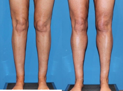 Man treated with Calf Implant - Calf augmentation involves placing solid silicone calf implants on top of the gastrocnemius muscles. For patients with naturally small calves, even with vigorous weight lifting, there is very little chance to improve the size of the calves without surgical help.
