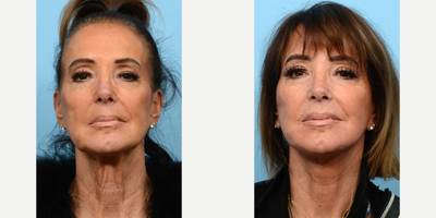 65-74 year old woman treated with Deep Plane Facelift, Eyelid Surgery, CO2 Laser - Dr. Wise performed a Deep Plane Facelift, Upper Blepharoplasty, and CO2 Laser Skin Resurfacing on this 68-year-old patient who wanted to refresh her appearance. He was able to reduce her excess eyelid skin, tighten her neck and jowls, and improve her overall skin tone and texture.