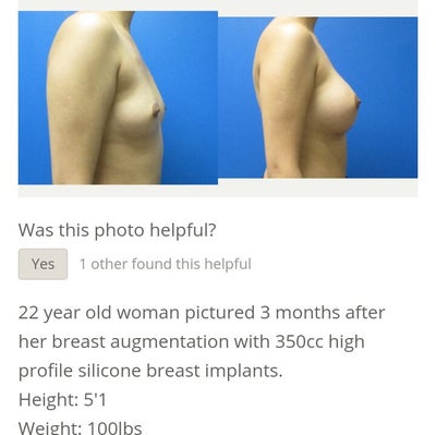 22 Years Old, No Kids, 34A to 34DD, 450cc Silicone Implants 