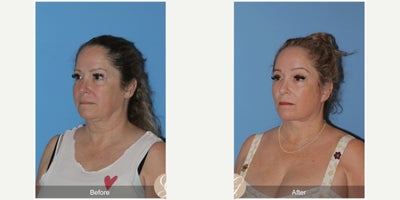 45-54 year old woman treated with Deep Plane Facelift, Neck Lift, Brow Lift, CO2 Laser, MACS Facelift - 52 year old treated with Deep Plane Face and Neck Lift, Temporal Brow Lift, CO2 Laser of Face, MAC