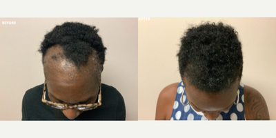 Woman treated with Hair Transplant - Woman treated with Hair Transplant forHair Loss Treatment