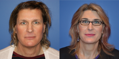 45-54 year old male treated with Facial Feminization Surgery - Facial Feminization Surgery