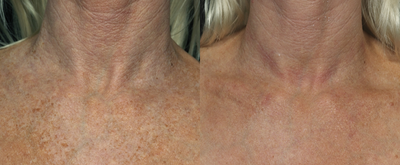 45-54 year old woman treated with Fraxel Laser - 1 month after 5 Fraxel treatments one month apart